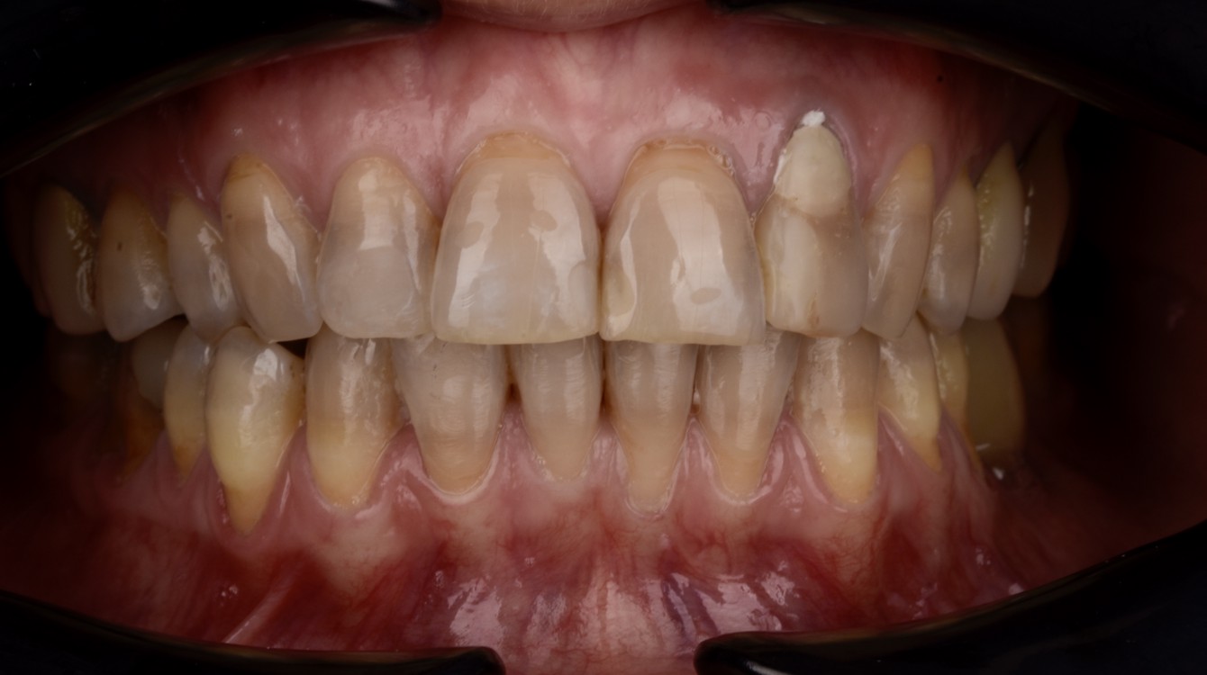 Intraoralna slika prije funkcionalno-estetske protetske rehabilitacije s parodontološkom terapijom, prikazuje oštećenja zubi i upalne promjene zubnog mesa.