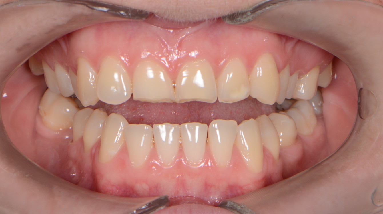 makover_1_ana_teeth_before