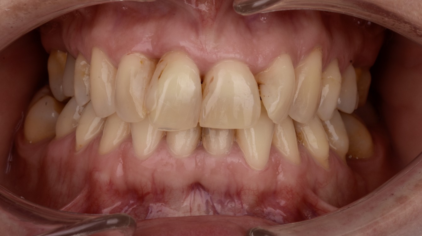 Intraoralna slika prije funkcionalno-estetske protetske rehabilitacije, prikazuje početno stanje zubi i potrebu za cjelovitom terapijom.