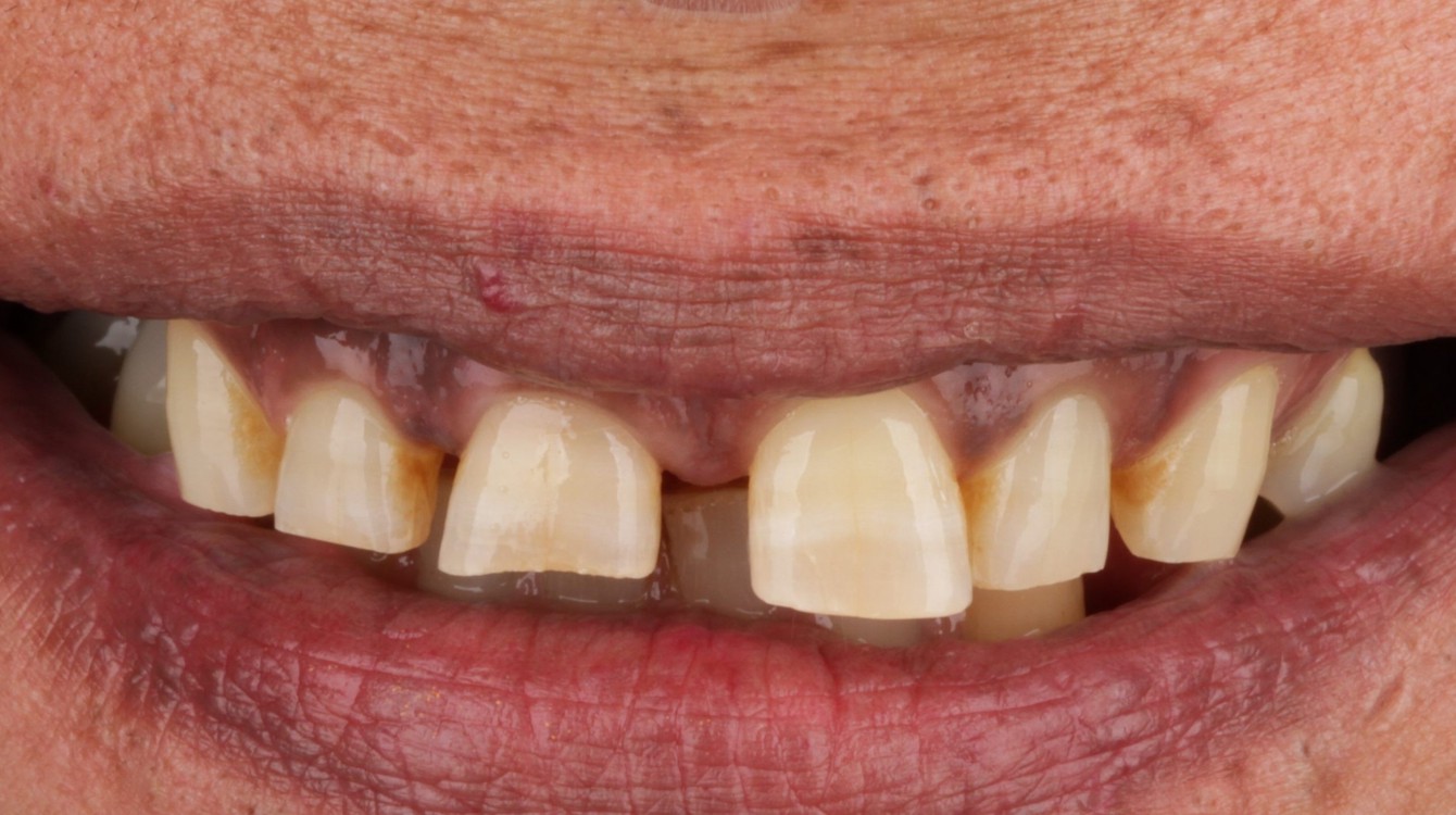 Copy of LINDITA_BEFORE1