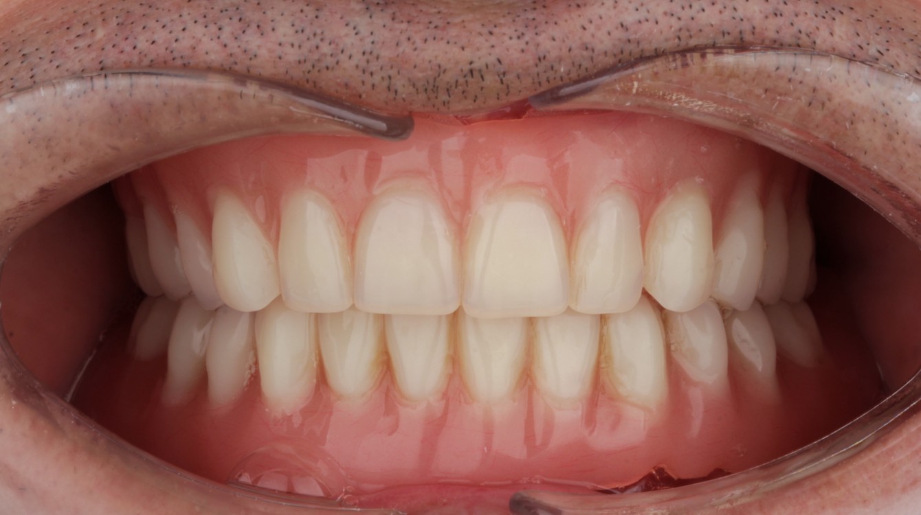 Intraoralna slika pacijenta prije ugradnje fiksne proteze i implantološke terapije, prikazuje stanje zubi i potrebu za funkcionalnom i estetskom rekonstrukcijom.