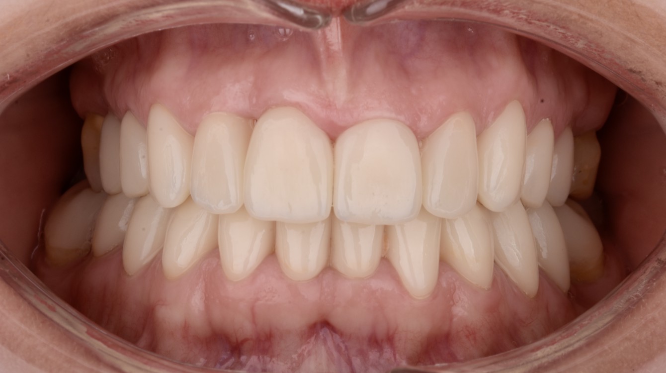 Gordana intraoralna poslije