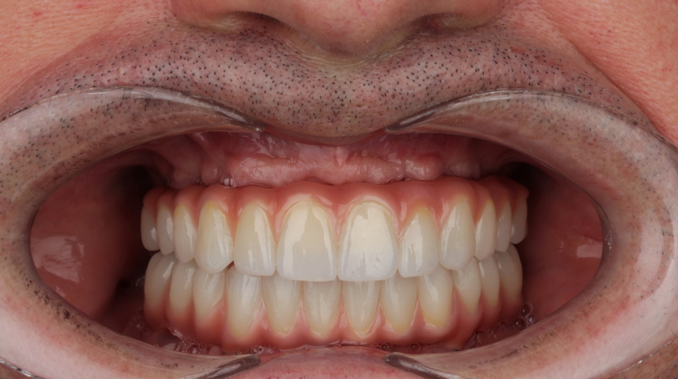 Intraoralna slika pacijenta nakon postavljanja fiksne proteze i implantološkog rada, prikazuje precizno izrađene protetske elemente i estetski usklađene zube.