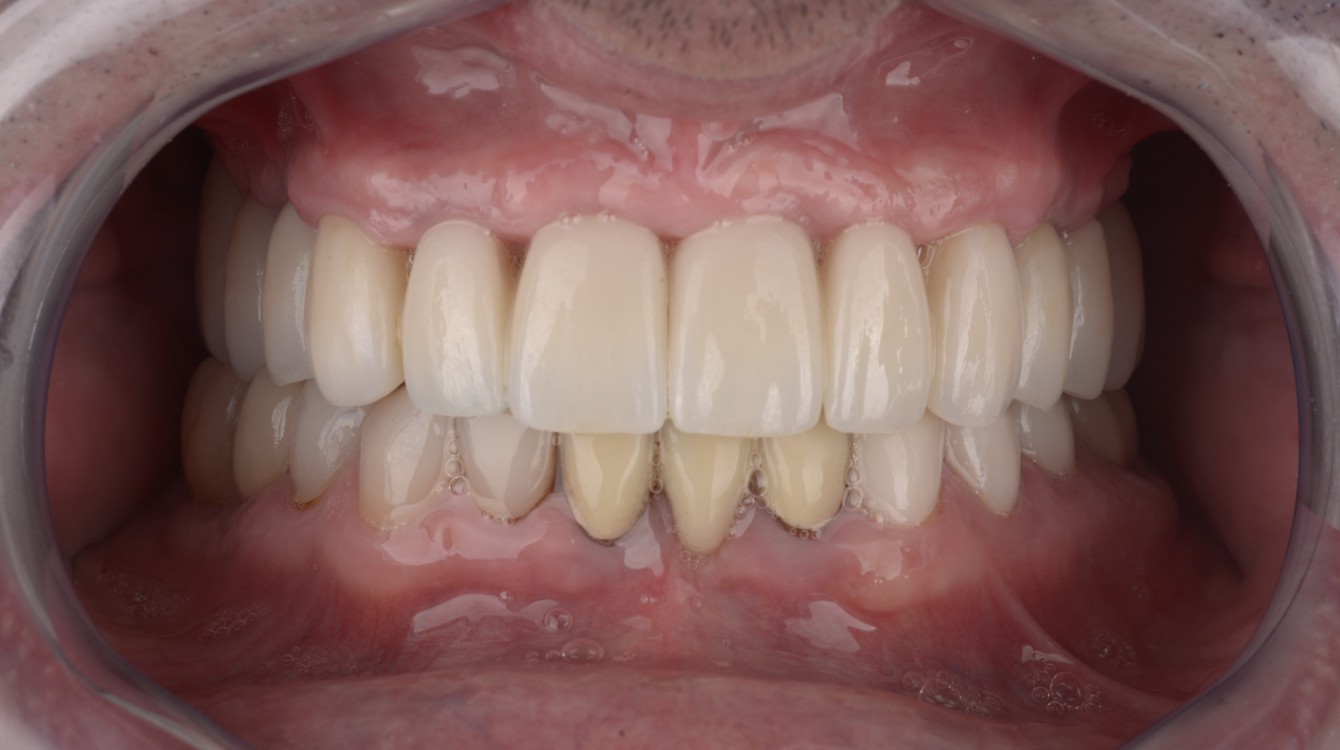 Intraoralna slika pacijentice nakon funkcionalno-estetske rehabilitacije s implanto-protetskom terapijom, prikazuje precizno izrađene protetske radove i zdravo oralno tkivo.