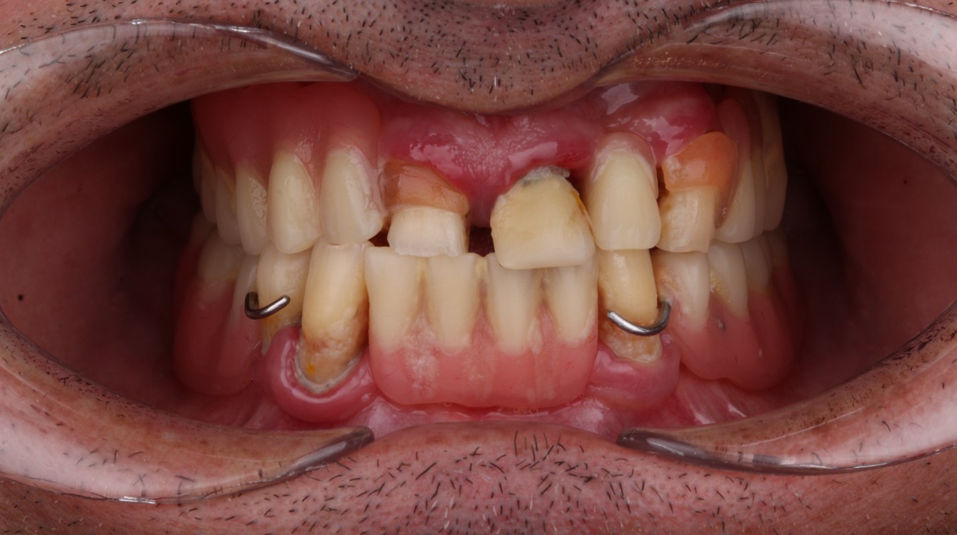 Intraoralna slika pacijenta prije implantološke i protetske terapije, prikazuje nedostatke u zubima i potrebu za rekonstrukcijom žvačnog sustava.