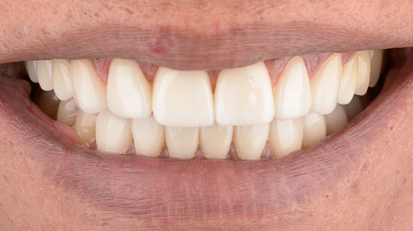 Copy of LINDITA_AFTER1