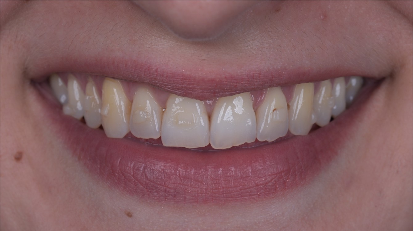 makeover_7_helena_teeth_before