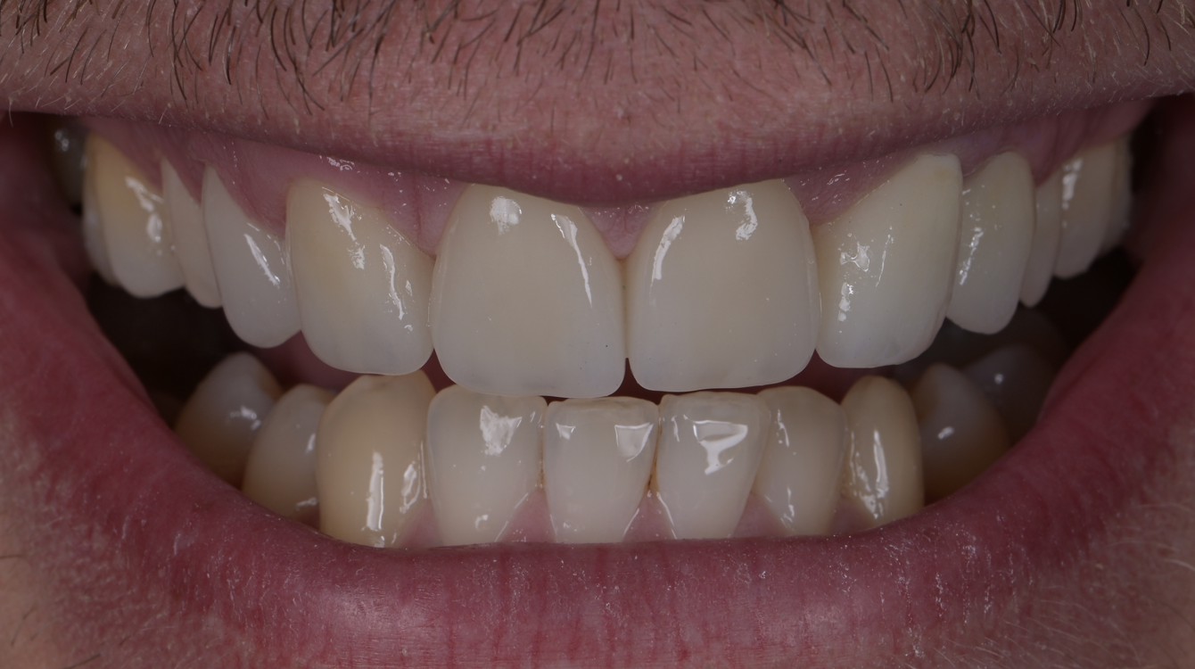 makeover_4_filip_teeth_after