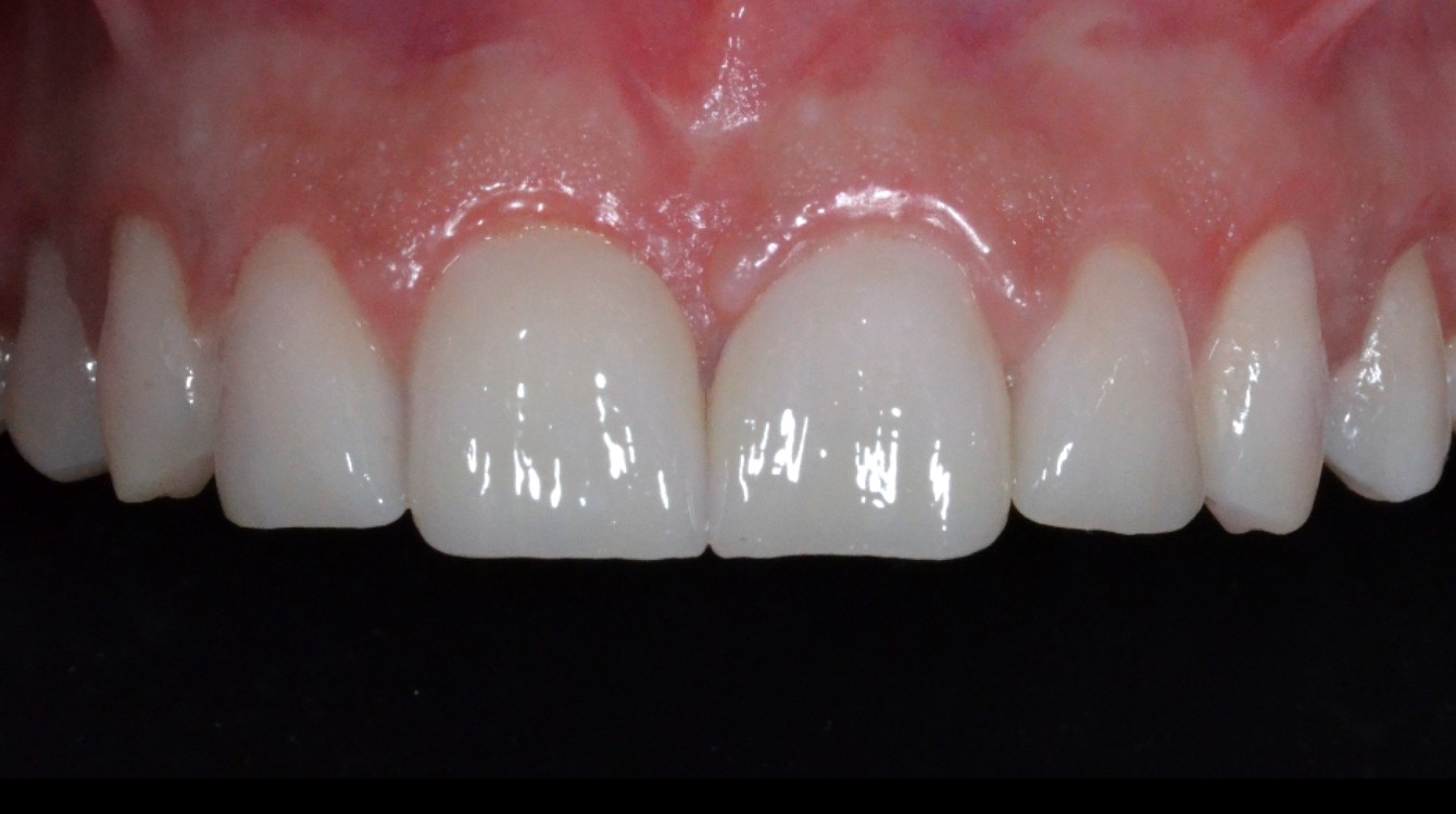 makeover_2_mia_teeth_after