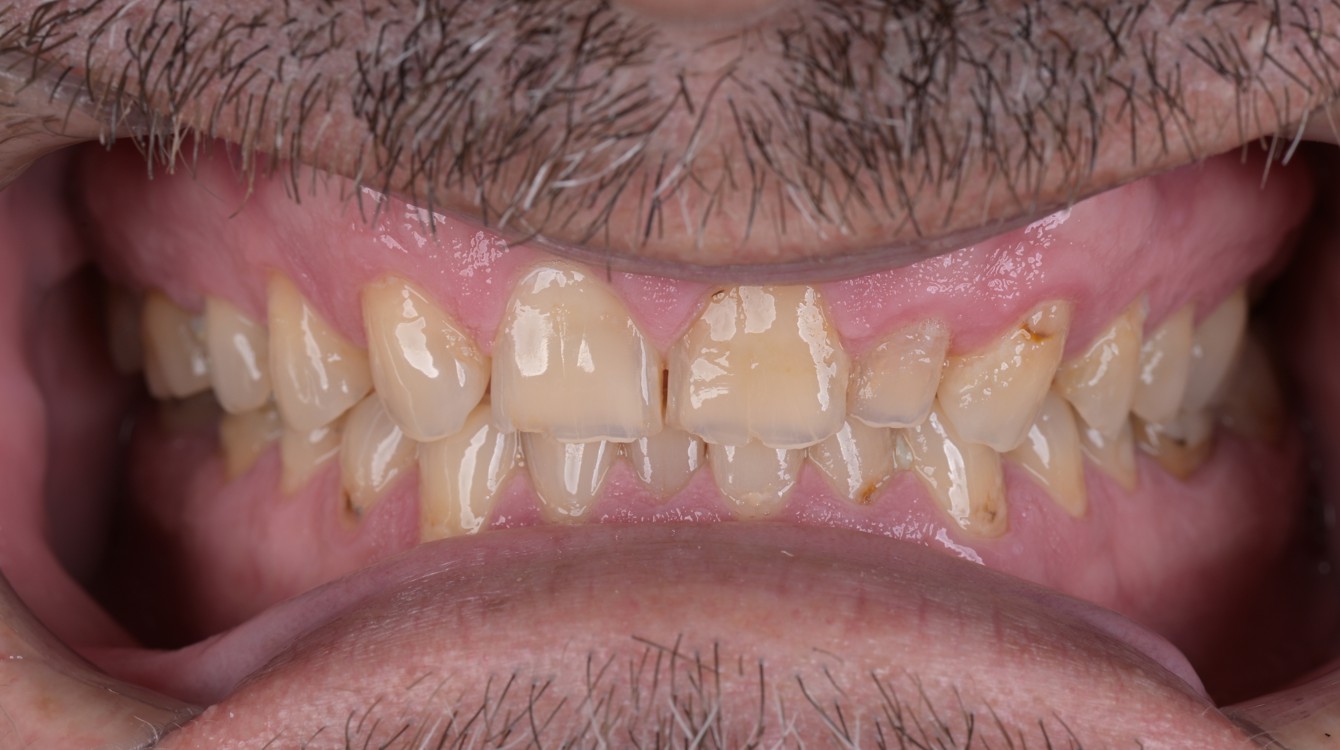 makeover_3_emin_teeth_before