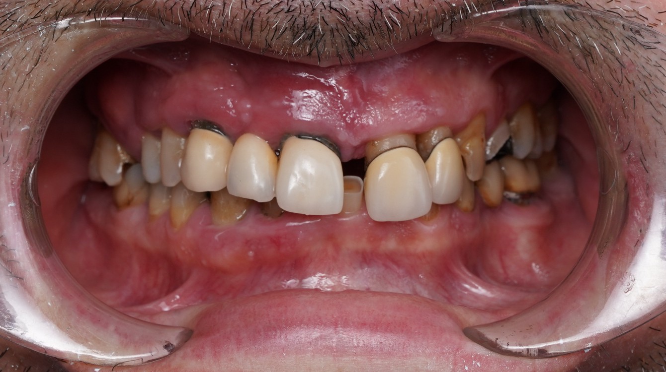 Intraoralna slika pacijenta prije implantološke terapije i postavljanja cirkonskih krunica, s vidljivim nedostacima u funkciji i estetici zubi.