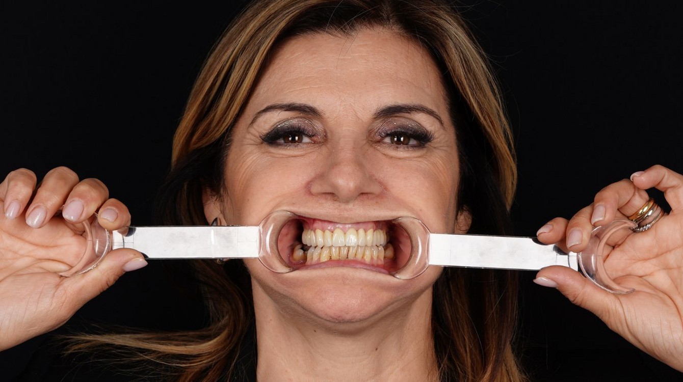 Portret pacijentice nakon implantološke terapije i estetske rekonstrukcije s cirkonskim krunicama, s prirodnim i osvježenim izgledom lica te obnovljenim osmijehom.