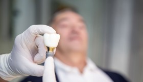 Što stoji iza cijene zubnih implantata_1