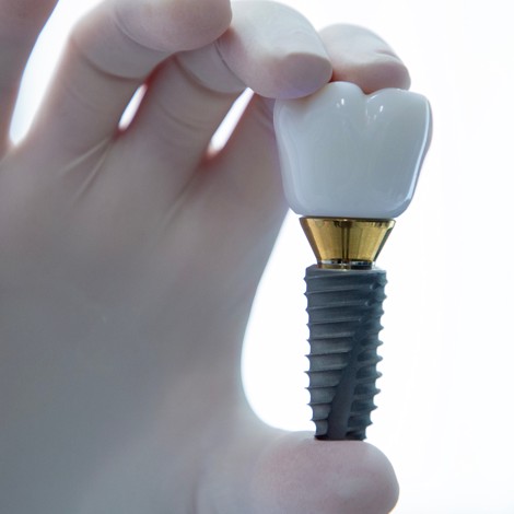 Zubni implantat