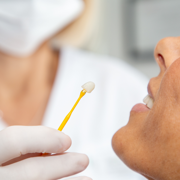 Doktorica pažljivo približava zubnu ljuskicu pacijentici na usta kako bi provjerila veličinu i oblik prije konačnog postavljanja.