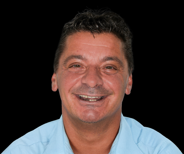 Portret pacijentice prije funkcionalno-estetske rehabilitacije s implanto-protetskom terapijom, s vidljivim početnim stanjem osmijeha i zubi.