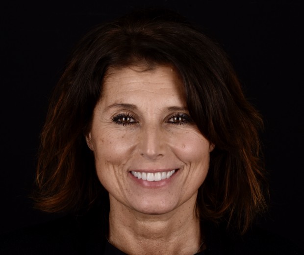 Slika pacijentice nakon funkcionalno-estetske protetske rehabilitacije s parodontološkom terapijom, s vidljivo poboljšanim zdravljem zubnog mesa i estetski obnovljenim osmijehom.