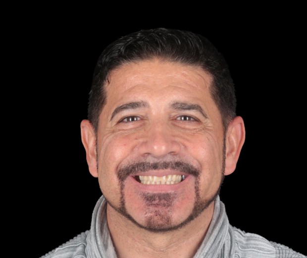 Portret pacijentice prije protetskog rada, s vidljivim početnim stanjem osmijeha i izraženom potrebom za estetskom i funkcionalnom rekonstrukcijom.