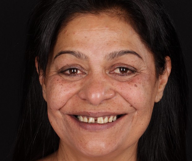 Slika pacijentice prije funkcionalno-estetske rehabilitacije s implanto-protetskom terapijom, s jasno vidljivim početnim stanjem zubi i funkcionalnim poteškoćama.