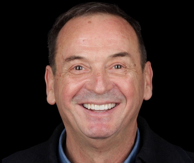 Portret pacijenta nakon završene terapije fiksnom protezom i implantološkim radom, s potpuno obnovljenim, funkcionalnim i estetski usklađenim osmijehom.