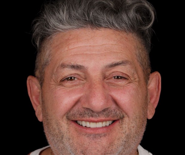 Portret pacijenta nakon implantološke i protetske terapije, s obnovljenim osmijehom koji odražava uspješan estetski i funkcionalni rezultat.