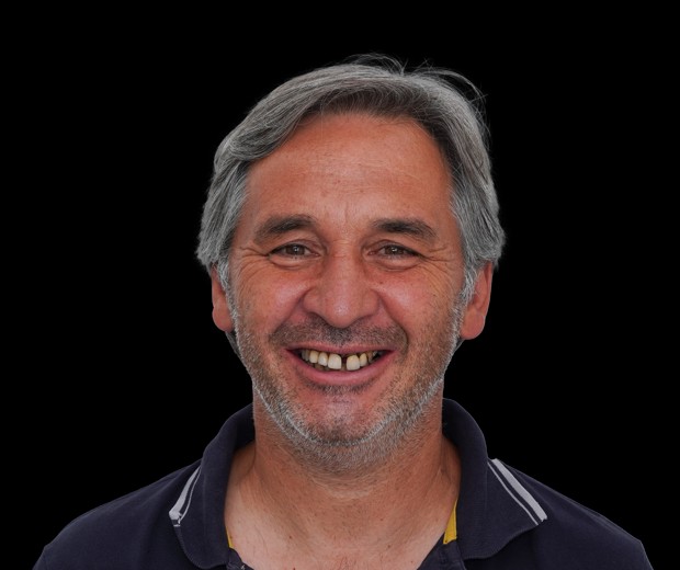 Portret pacijenta prije implantološke terapije i estetske rekonstrukcije pomoću cirkonskih krunica, s vidljivim početnim stanjem osmijeha i funkcionalnim nedostacima.