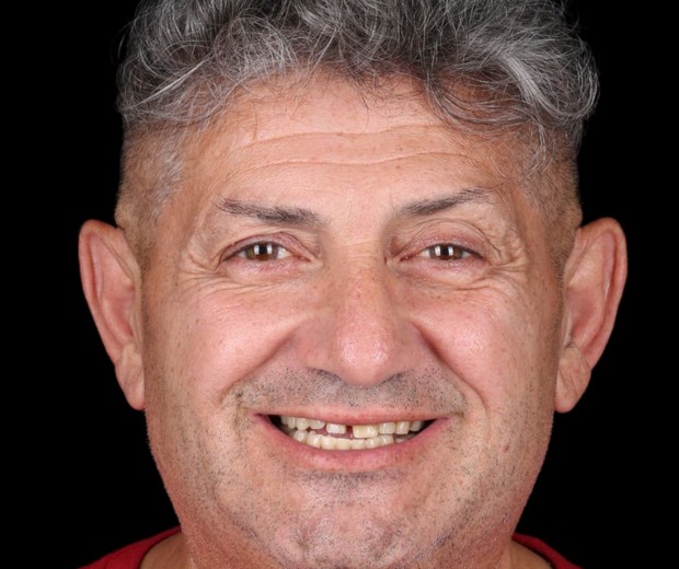 Portret pacijenta prije implantološke i protetske terapije, s vidljivim početnim stanjem osmijeha i potrebom za sveobuhvatnom dentalnom rehabilitacijom.