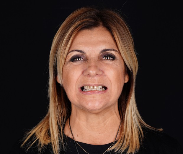 Portret pacijentice prije implantološke terapije i ugradnje cirkonskih krunica, s vidljivim gubitkom zubi i potrebom za estetskom i funkcionalnom rekonstrukcijom.