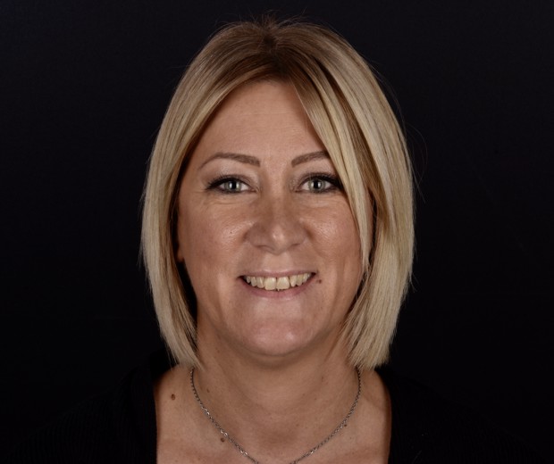 Slika pacijentice prije funkcionalno-estetske protetske rehabilitacije, prikazuje početno stanje zubi i potrebu za sveobuhvatnom terapijom.