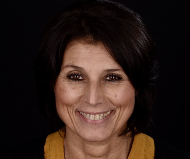 Slika pacijentice prije funkcionalno-estetske protetske rehabilitacije s parodontološkom terapijom, s vidljivim oštećenjima zubi i upalnim promjenama na zubnom mesu.