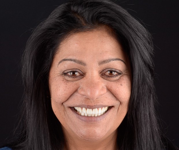 Slika pacijentice nakon funkcionalno-estetske rehabilitacije s implanto-protetskom terapijom, s prirodnim i estetski usklađenim osmijehom.