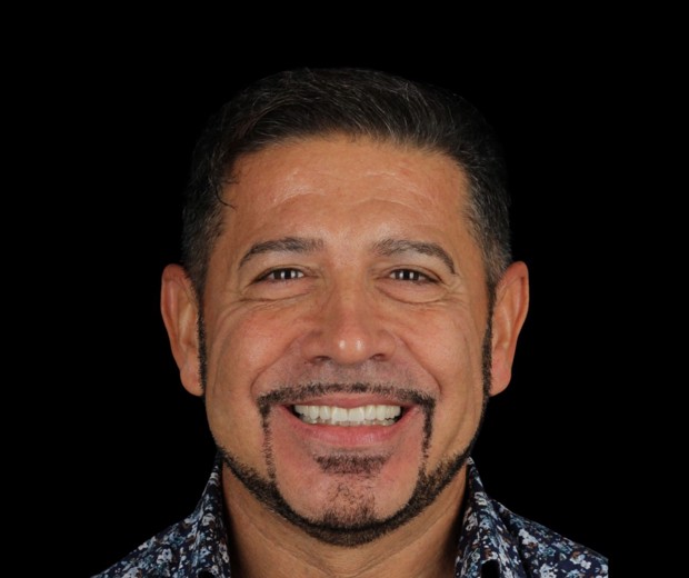 Portret pacijenta nakon protetskog rada, s prirodnim i skladnim osmijehom koji odražava uspješan estetski i funkcionalni rezultat terapije.