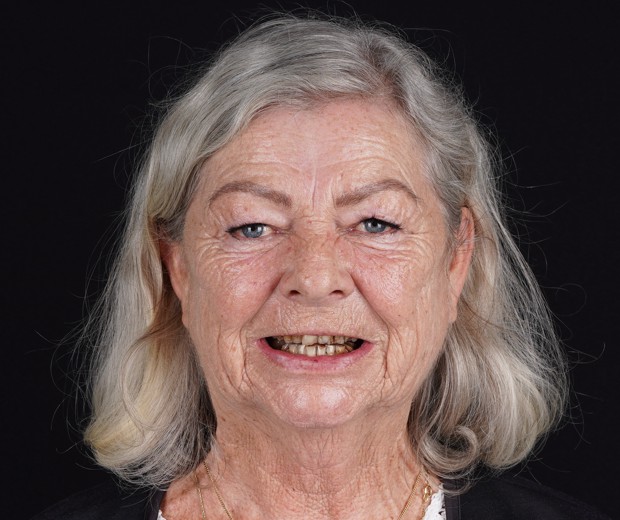 Pacijentica prije početka protetskog zahvata, dokumentirano početno stanje zubi radi usporedbe s konačnim estetskim rezultatom.