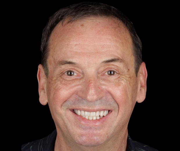 Portret pacijenta prije terapije fiksnom protezom i implantološkim radom, s vidljivim početnim stanjem osmijeha i zubi.