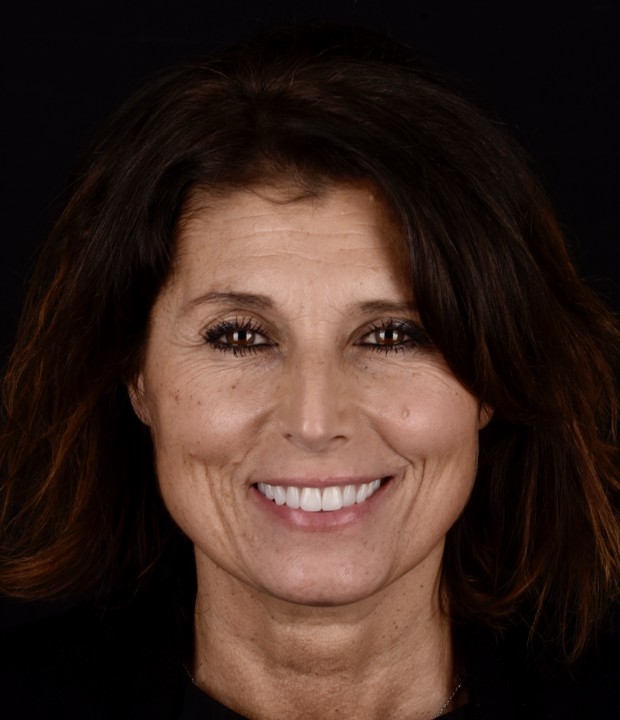 Slika pacijentice nakon funkcionalno-estetske protetske rehabilitacije s parodontološkom terapijom, s vidljivo poboljšanim zdravljem zubnog mesa i estetski obnovljenim osmijehom.