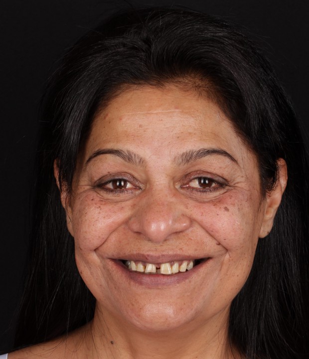 Slika pacijentice prije funkcionalno-estetske rehabilitacije s implanto-protetskom terapijom, s jasno vidljivim početnim stanjem zubi i funkcionalnim poteškoćama.