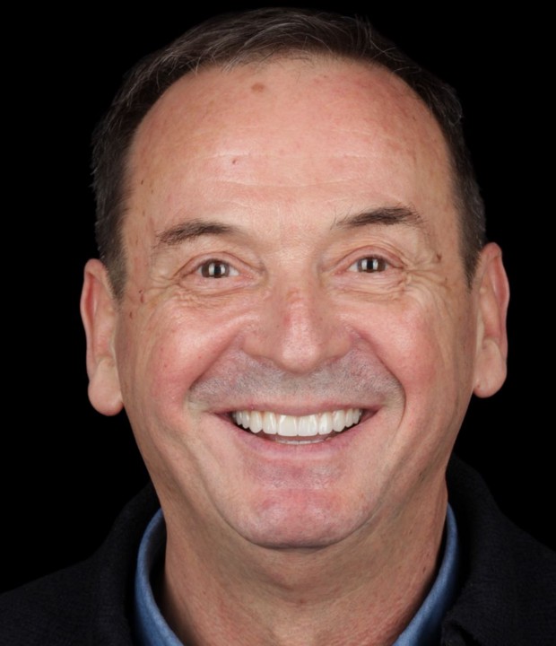 Portret pacijenta nakon završene terapije fiksnom protezom i implantološkim radom, s potpuno obnovljenim, funkcionalnim i estetski usklađenim osmijehom.