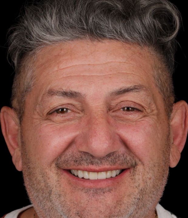 Portret pacijenta nakon implantološke i protetske terapije, s obnovljenim osmijehom koji odražava uspješan estetski i funkcionalni rezultat.