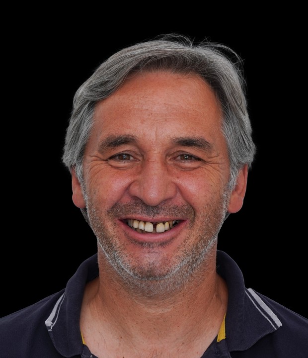 Portret pacijenta prije implantološke terapije i estetske rekonstrukcije pomoću cirkonskih krunica, s vidljivim početnim stanjem osmijeha i funkcionalnim nedostacima.