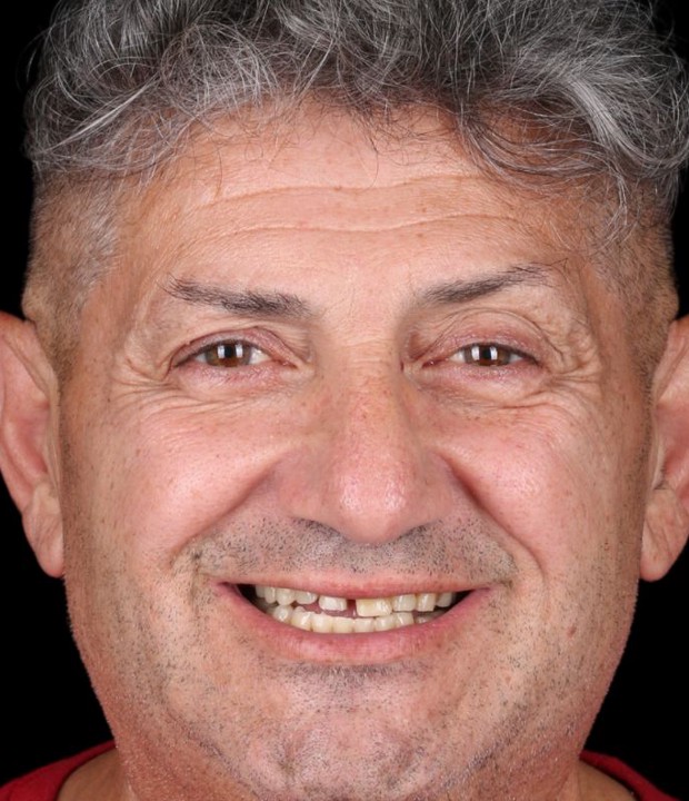 Portret pacijenta prije implantološke i protetske terapije, s vidljivim početnim stanjem osmijeha i potrebom za sveobuhvatnom dentalnom rehabilitacijom.