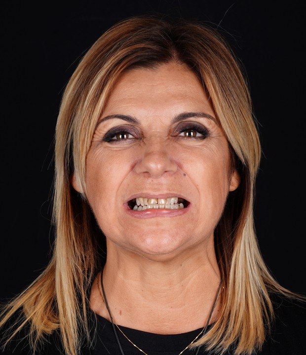 Portret pacijentice prije implantološke terapije i ugradnje cirkonskih krunica, s vidljivim gubitkom zubi i potrebom za estetskom i funkcionalnom rekonstrukcijom.