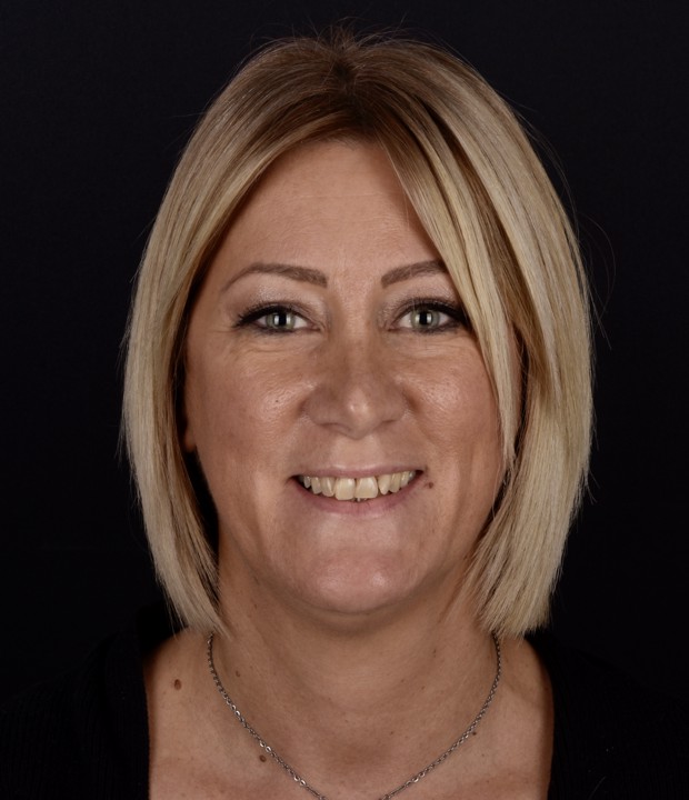 Slika pacijentice prije funkcionalno-estetske protetske rehabilitacije, prikazuje početno stanje zubi i potrebu za sveobuhvatnom terapijom.