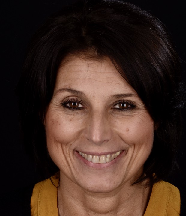 Slika pacijentice prije funkcionalno-estetske protetske rehabilitacije s parodontološkom terapijom, s vidljivim oštećenjima zubi i upalnim promjenama na zubnom mesu.