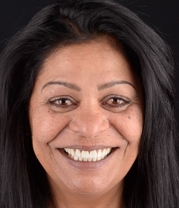 Slika pacijentice nakon funkcionalno-estetske rehabilitacije s implanto-protetskom terapijom, s prirodnim i estetski usklađenim osmijehom.