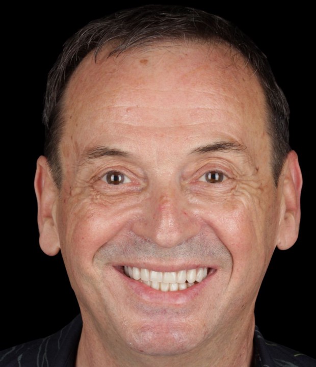 Portret pacijenta prije terapije fiksnom protezom i implantološkim radom, s vidljivim početnim stanjem osmijeha i zubi.