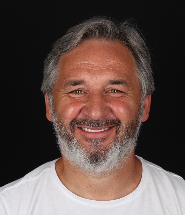 Portret pacijenta nakon implantološke terapije i estetske rekonstrukcije pomoću cirkonskih krunica, s prirodnim, skladnim i funkcionalno obnovljenim osmijehom.