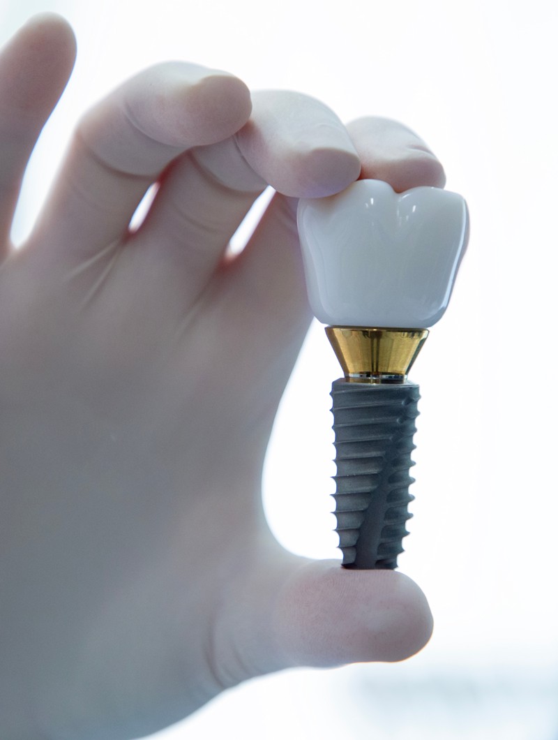 Zubni implantat