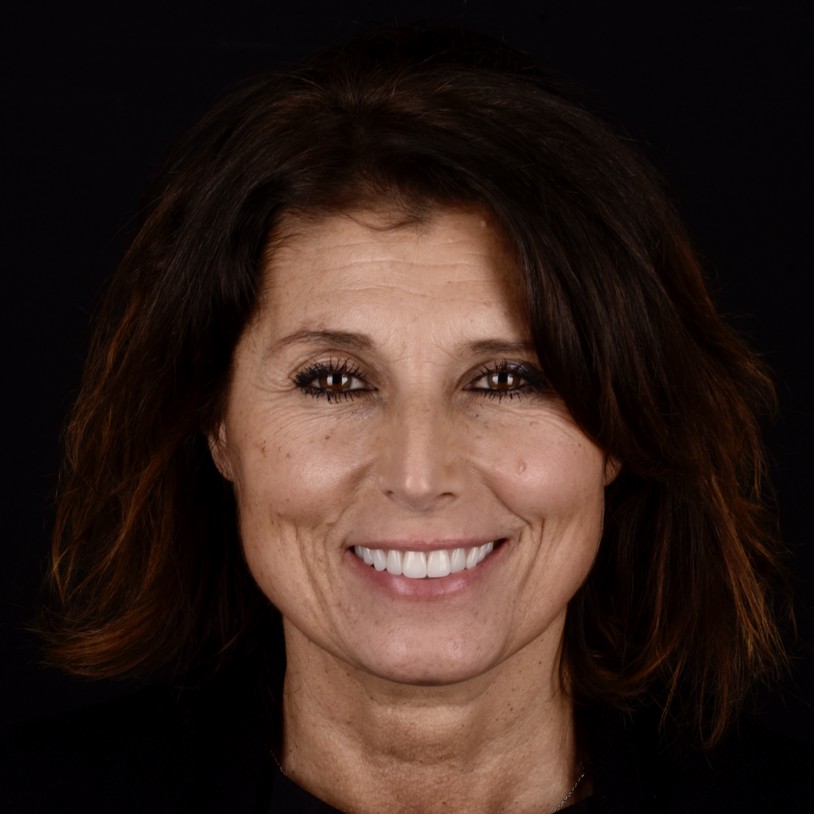 Slika pacijentice nakon funkcionalno-estetske protetske rehabilitacije s parodontološkom terapijom, s vidljivo poboljšanim zdravljem zubnog mesa i estetski obnovljenim osmijehom.