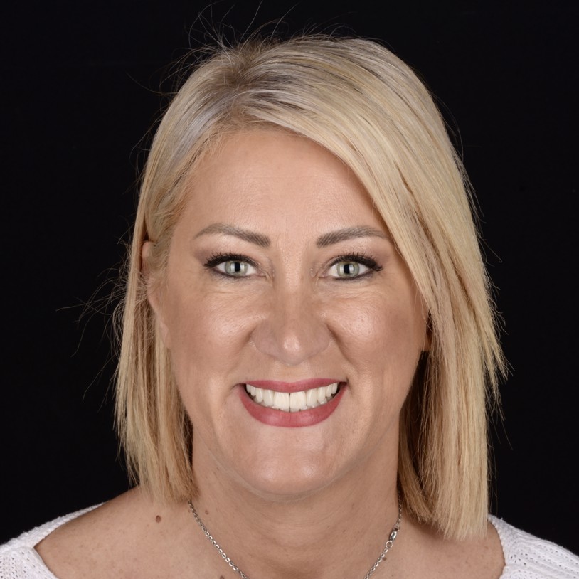 Slika pacijentice nakon funkcionalno-estetske protetske rehabilitacije, s potpunom rekonstrukcijom zubi i estetski skladnim osmijehom.